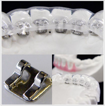 シークレット ステップ123 ＋ 2Dリンガルブラケット