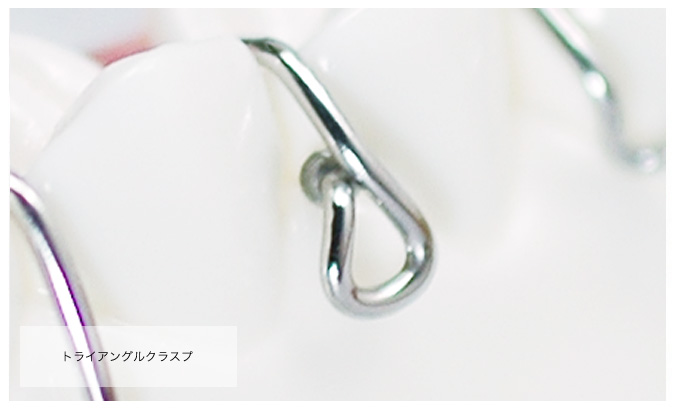 トライアングルクラスプ
